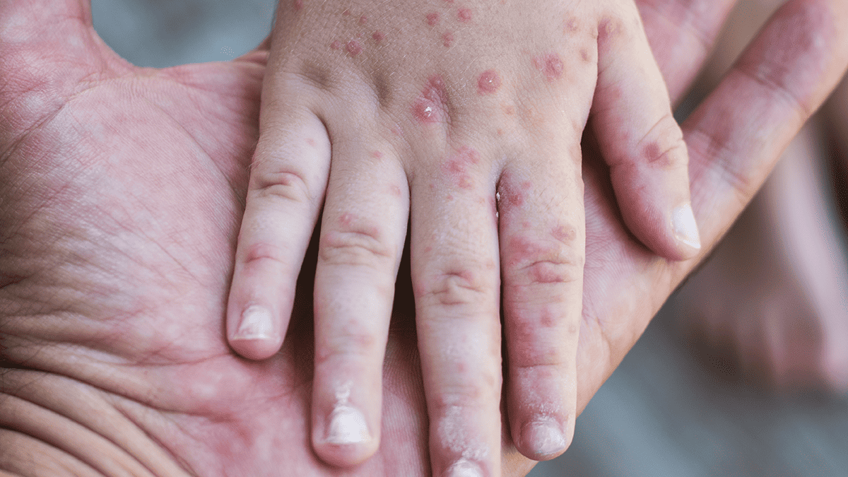 measles cases rise canada CP photo